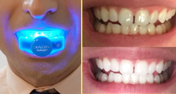 Discover Home Teeth Whitening Products