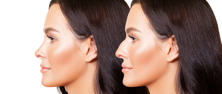 Rhinoplasty – One of the Most Demanded Plastic Surgeries